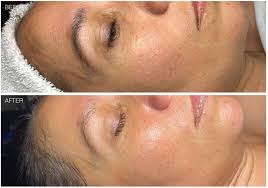 Microdermabrasion