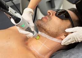 Laser Hair Removal